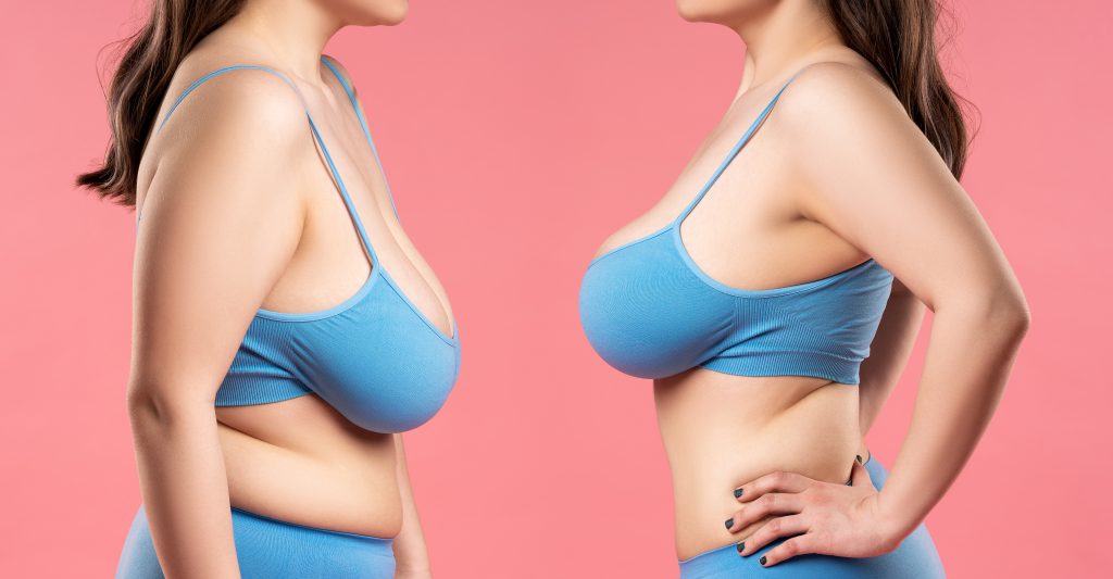 Before and after breast augmentation