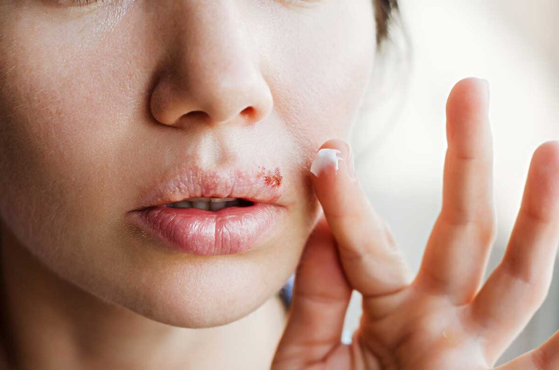 How is Herpes Transmitted Non-Sexually?