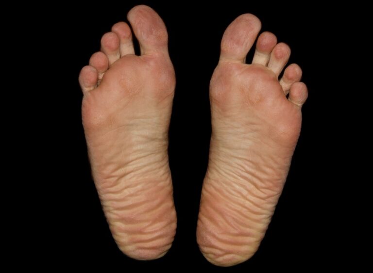 How to Dissolve Bone Spurs Naturally
