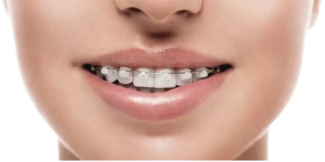 Clear Braces: Correct Your Teeth Alignment & Get That Gorgeous Smile!